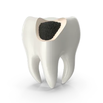 Лечение кариеса фронтальных зубов